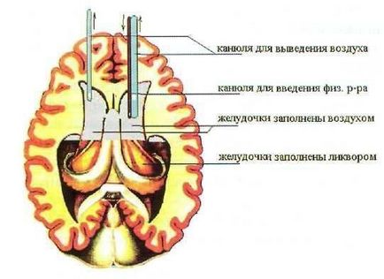 травматична пневмоцефалія