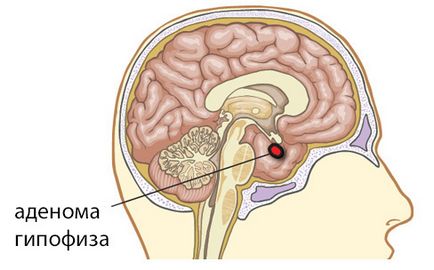 Видалення аденоми гіпофіза операція, способи, наслідки