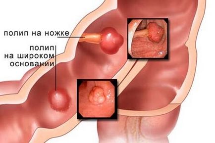 Eliminarea polipilor din intestin