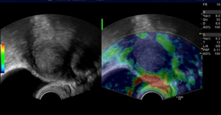 Elastografie ultrasonică (sonoelastografie)