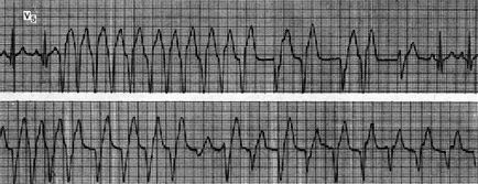 Idioventricular gyorsított ritmus (klinikai kép) - rohamokban fellépő kamrai zavarok