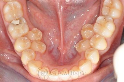 Eliminarea perforațiilor în domeniul furcațiilor și rădăcinilor dinților