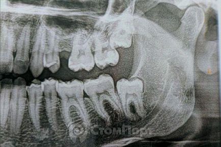 Eliminarea perforațiilor în domeniul furcațiilor și rădăcinilor dinților