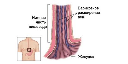 Varicele varice ale esofagului 1, 2, 3 grade, clasificare, cauze, simptome, tratament