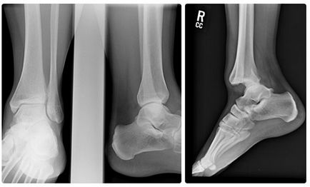Вивих щиколотки лікування, симптоми і перша допомога