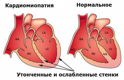 Efectul alcoolului asupra sistemului cardiovascular, de ce suferă inima după el?