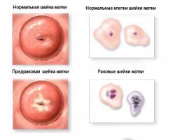 Питання чи може поліп матки або поліп шийки матки викликати рак