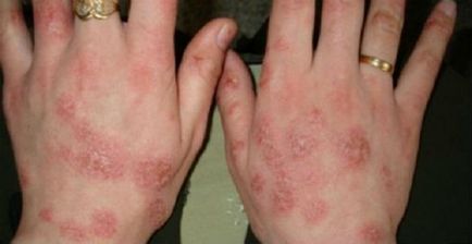 Eczema cronică a mâinilor - metode de tratament