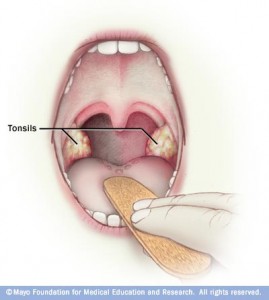 Хронічний тонзиліт, профілактика і лікування - ваш домашній доктор