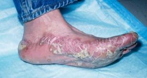 Infecție cu simptome și tratament cu rubrofit (rubomicoză)
