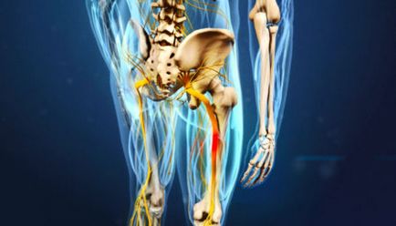 Strângerea nervului în picior, simptome de șold și tratament, ce trebuie să faceți