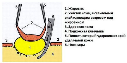 Жировик на обличчі, столітті, близько очей - фото, причини, як позбутися