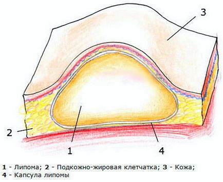 Жировик на обличчі, столітті, близько очей - фото, причини, як позбутися