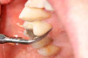 Зубні камені способи їх видалення в домашніх умовах