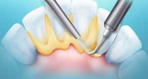 Зубні камені способи їх видалення в домашніх умовах
