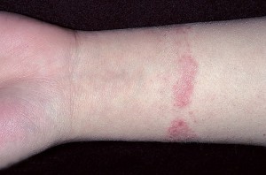 Алергія на метал симптоми, лікування, харчування