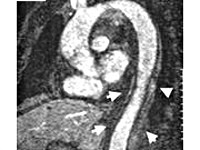 Aortită - cauze, simptome, diagnostic și tratament