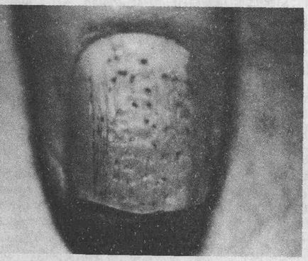 Заболявания на ноктите - Медицинска енциклопедия