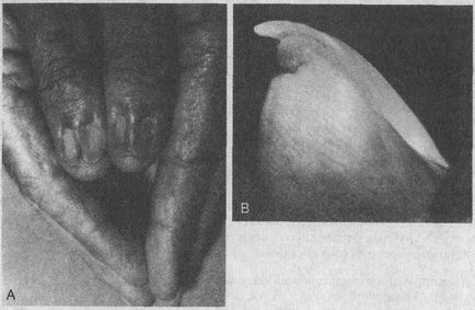 Хвороби нігтів - медична енциклопедія