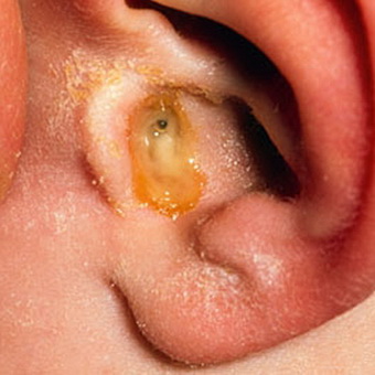Betegségei a fül a fényképet és a hagyományos módszerek gyulladás kezelésére a belső és a középfül