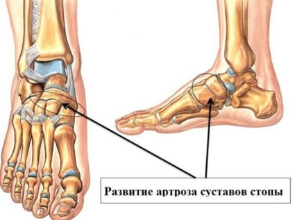 Біль в плеснової частини стопи - які захворювання і стану викликають