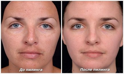 Curățarea feței de la un cosmetolog - tipuri de proceduri, fotografii înainte și după, cum se face o curățare profesională