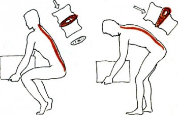 Що таке діскоз хребта і як його лікувати