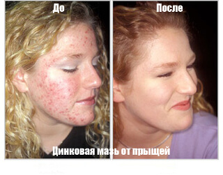 Zincul de zinc din acnee cum functioneaza si cand se aplica pentru a scapa de defecte ale pielii