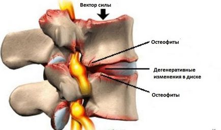 Disco al coloanei vertebrale lombare