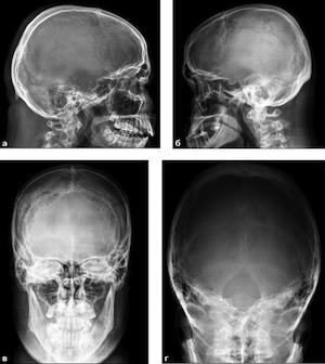 Care este craniografia craniului?