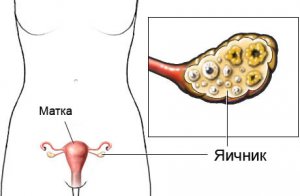 Două corpuri galbene în ovare diferite sau într-unul în timpul sarcinii și probabilitatea unei concepții multiple