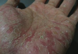 Eczema este contagioasă sau nu și este transmisă de la persoană la persoană