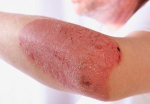 Eczema este contagioasă sau nu și este transmisă de la persoană la persoană