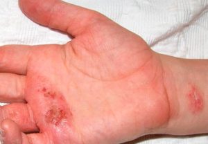 Eczema este contagioasă sau nu și este transmisă de la persoană la persoană