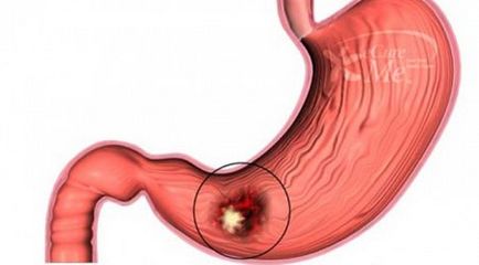 Cauze gastrita erozivă, simptome, tratament și dietă