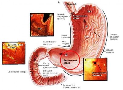 Cauze gastrita erozivă, simptome, tratament și dietă