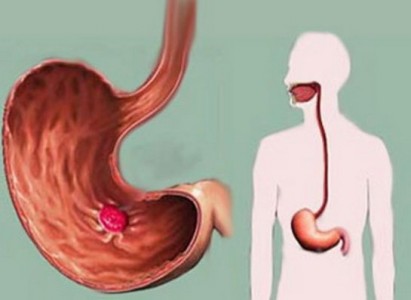 Erozív gastritis okok, tünetek, kezelés és diéta