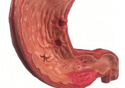 Cauze gastrita erozivă, simptome, tratament și dietă
