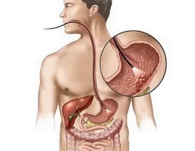 Erozív gasztritisz okoz, a tünetek, a kezelés, és a diéta (gastritis) Erozív gastritis okok, tünetek, kezelés és diéta