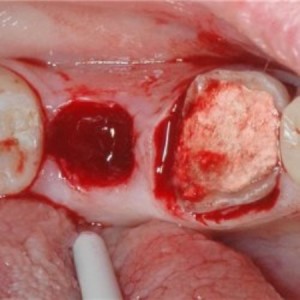Гемостатична губка для зупинки кровотечі після видалення зуба
