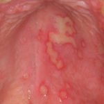 Herpesul din gură la adulți și copii tratați, fotografii și simptome