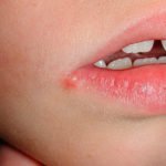 Герпес в роті у дорослих і дітей лікування, фото і симптоми