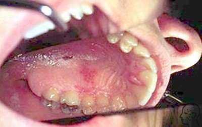 Герпес в роті у дорослих і дітей лікування, фото і симптоми