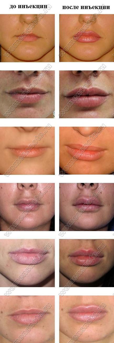 Гіалуронова кислота в губи в домашніх умовах - гіалуронова кислота для обличчя в домашніх умовах