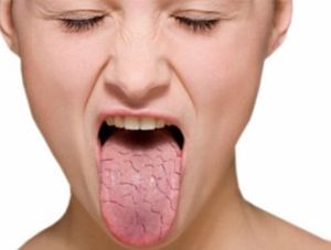 Гіпосалівація (олігосіалія, сухість у роті) причини, лікування, наслідки