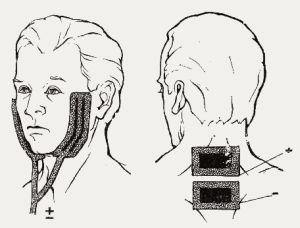 Hyposeivation (oligosyalya, uscăciunea gurii) cauze, tratament, consecințe