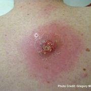Гнійні запалення шкіри і підшкірної клітковини - шпаргалки для швидкої допомоги