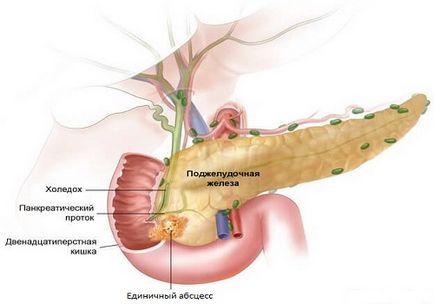 Purătoarea pancreatitei determină dezvoltarea, diagnosticul și tratamentul