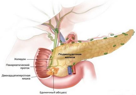 Гнійний панкреатит причини розвитку, діагностика та лікування