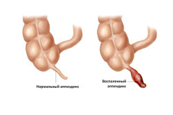 Simptome și tratament pentru pancreatită purulentă